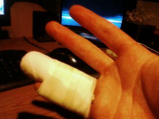 nobo's hand injury nobo's hand injury