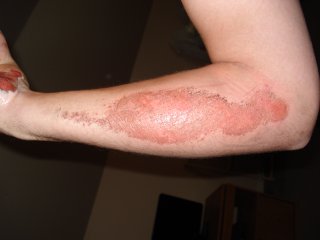 nellem's aftermath (i.e. after the motorcycle accident) 2 nellem's aftermath (i.e. after the motorcycle accident) 2