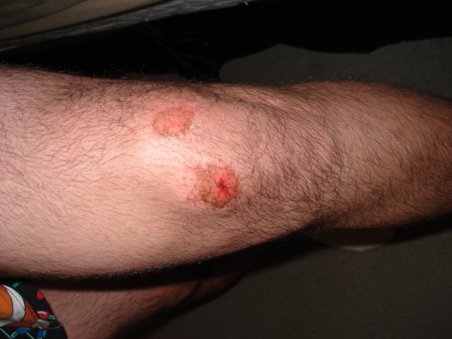 nellem's aftermath (i.e. after the motorcycle accident) 3