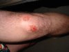 nellem's aftermath (i.e. after the motorcycle accident) 3