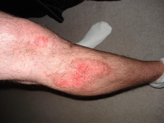 nellem's aftermath (i.e. after the motorcycle accident) 4
