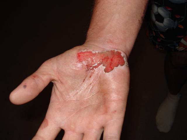 nellem's aftermath (i.e. after the motorcycle accident) 6