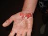 nellem's aftermath (i.e. after the motorcycle accident) 6