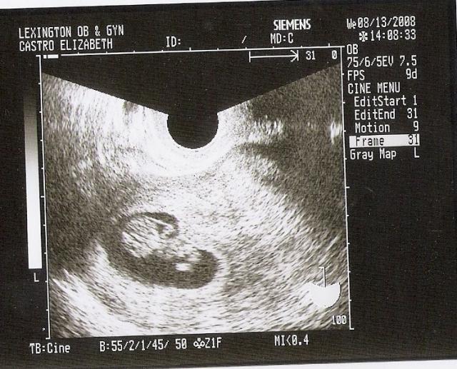 1st Ultrasound 9 weeks 5 days along